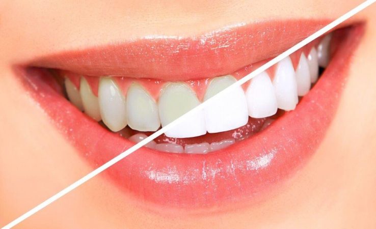 הלבנת שיניים בתאי שיזוף